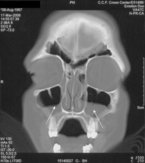 Computed tomography scan showing acute sinusitis