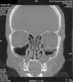tomography scan showing chronic sinusitis