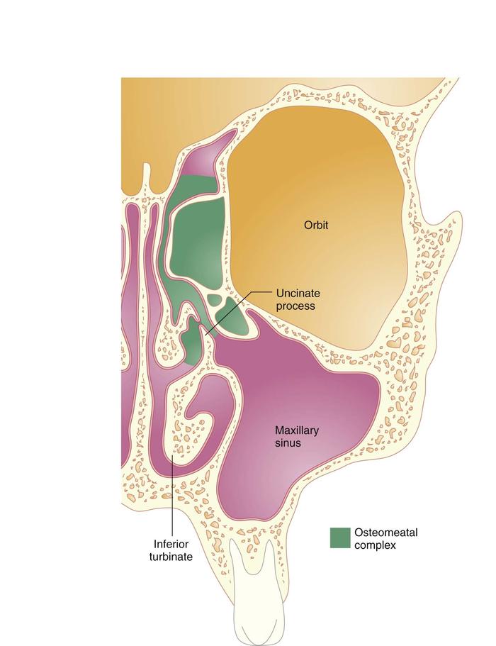 Pathophysiology Of Sinusitis In Flow Chart