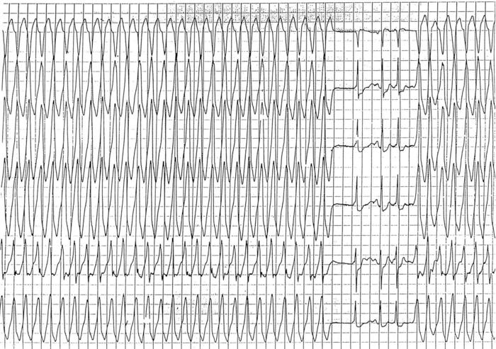 ecg criteria of non st segment elevation myocardial infarction