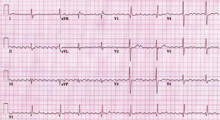 Telemetry Heart Rate Chart