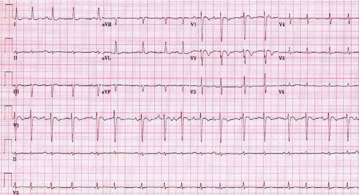 Coarse Atrial Fibrillation Vs Atrial Flutter Slidedocnow