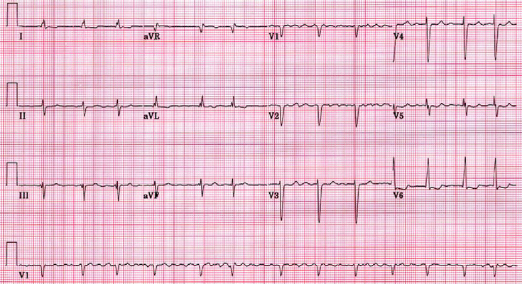 Afib Ekg Chart