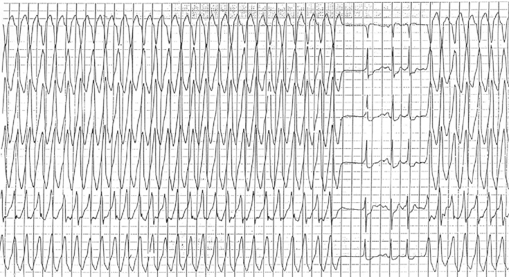 Afib Chart