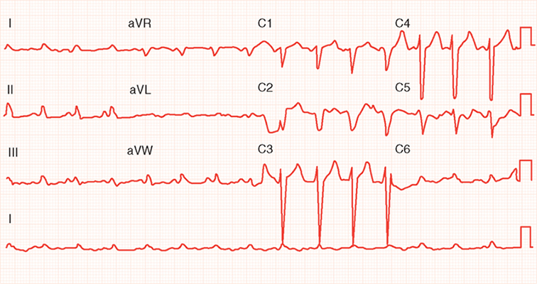 Adderall and cardiovascular risk: A.