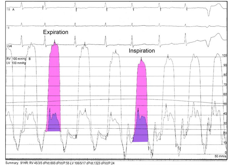 What is being done during a right heart catheterization?