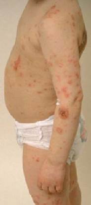 Figure 5: Atopic dermatitis with  secondary impetiginization.