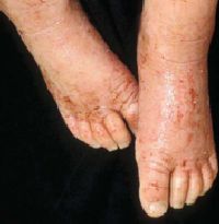 Figure 6: Weeping, lichenified,  erythematous plaques with honey-colored crust (atopic dermatitis with secondary  impetiginization).