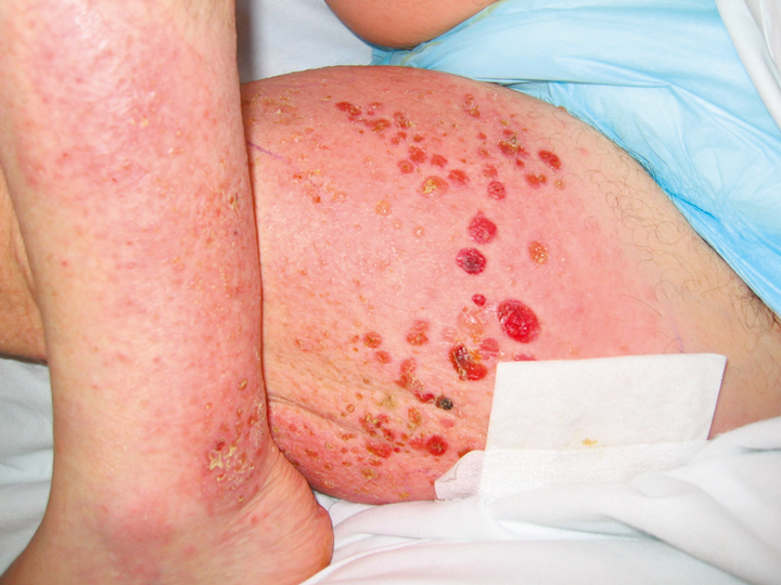 Bullous Pemphigoid - American Osteopathic College of ...