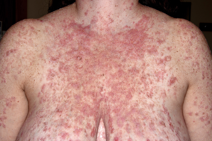 Varicella Chicken Pox Picture Image on MedicineNet.com