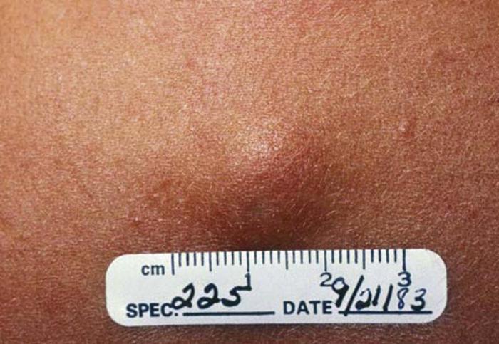 What causes numerous lumps under the skin?