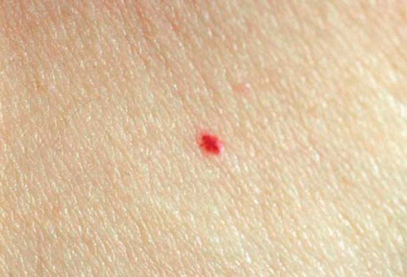 Cherry Angiomas And Stress