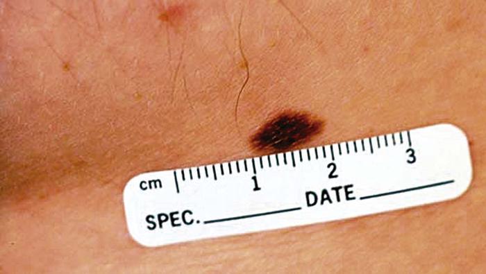 How is atypical melanoma diagnosed?