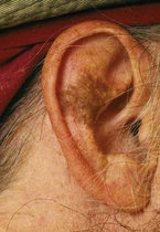 Lentigo maligna on the right ear.