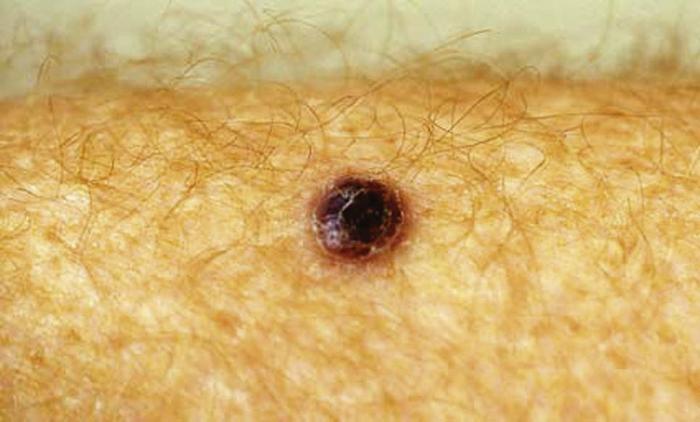 What is the prognosis for melanoma?