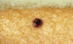 Nodular melanoma on the forearm.