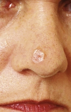 Desmoplastic melanoma.