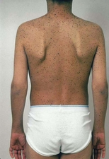 Multiple lentigines in a boy with LEOPARD syndrome.