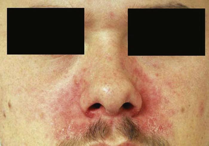 common warts on face. Common cutaneous disorders