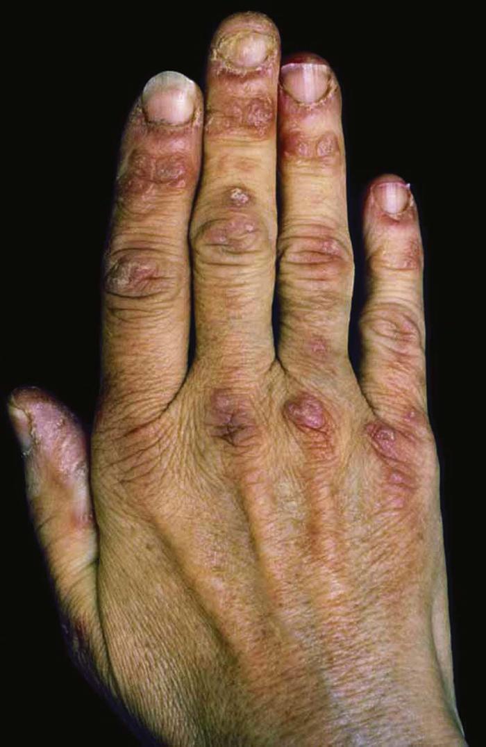 Dermatologic Signs Of Systemic Disease