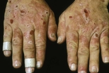 Eroded blisters on the hands of a man with porphyria cutanea tarda and hepatitis C.