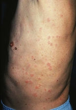 Urticaria on the flank