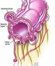 Figure 1: Colonic diverticulae on the mesenteric side of the colonic wall.