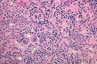 Bone marrow biopsy in polycythemia vera