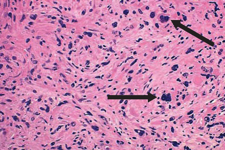 What is end stage myelofibrosis?