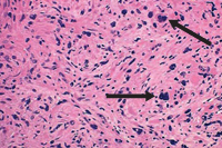 Bone marrow biopsy - fibrotic stage