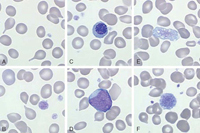 Peripheral blood abnormalities in CIMF