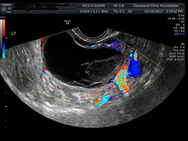 Ovarian Cyst Size Chart In Cm