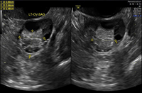 Dermoid cyst