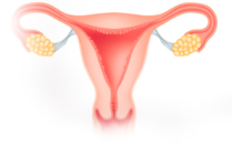 Endometrial Cancer