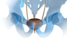 Urinary Incontinence