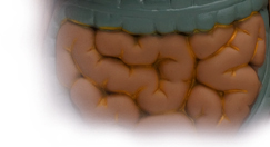 Crohns Disease