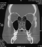 scan of a normal sinus anatomy