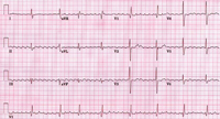 Typical atrial flutter
