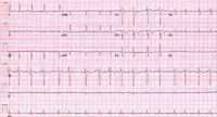 Multifocal atrial tachycardia