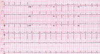 Multifocal atrial tachycardia