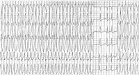 Wolff-Parkinson-White syndrome