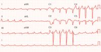 ventricular fibrillation