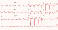 ventricular fibrillation