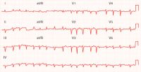 ventricular fibrillation