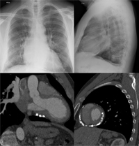 Calcified pericardium