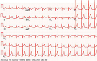 Stage 1 of acute pericarditis