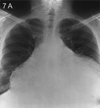 Chest radiograph