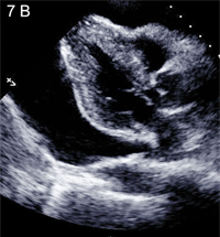 Chest echocardiography