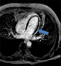 Hemopericardium