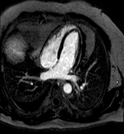 pericardial cavity